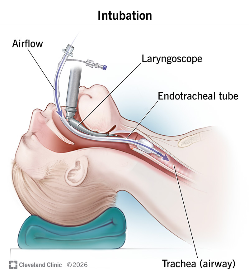 Intubation anatomy diagram showing the endotracheal tube sealed in the trachea
