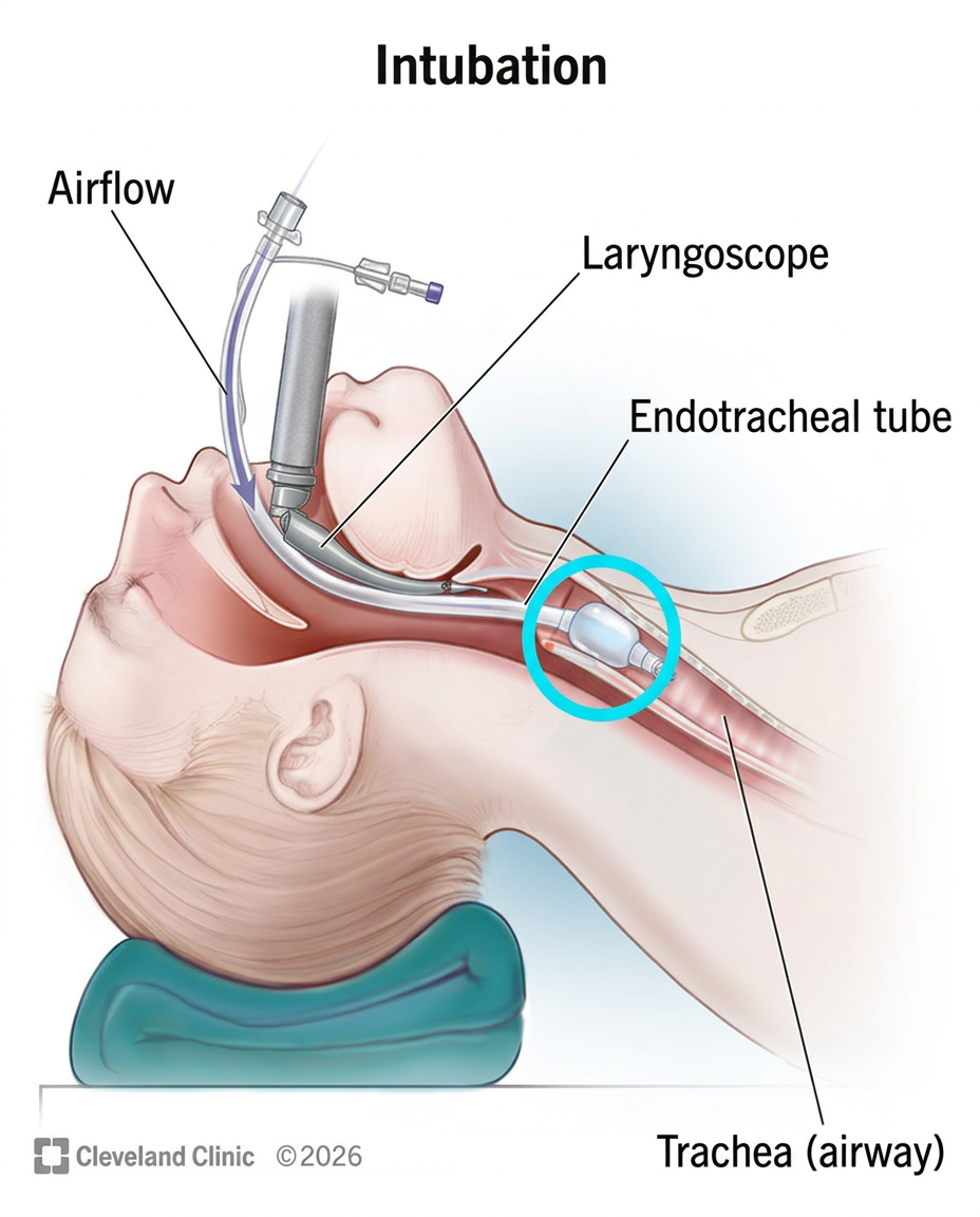 Intubation anatomy diagram showing the endotracheal tube sealed in the trachea